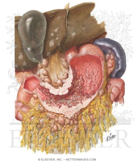 Watermarked preview of unlabeled image: Spread of Carcinoma of Stomach