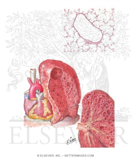 Watermarked preview of unlabeled image: Congenital Lobar Emphysema