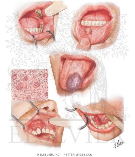 Benign Tumors of Oral Cavity