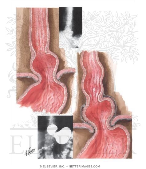 Watermarked preview of unlabeled image: Thoracic Stomach I - Short Esophagus, Sliding Hernia