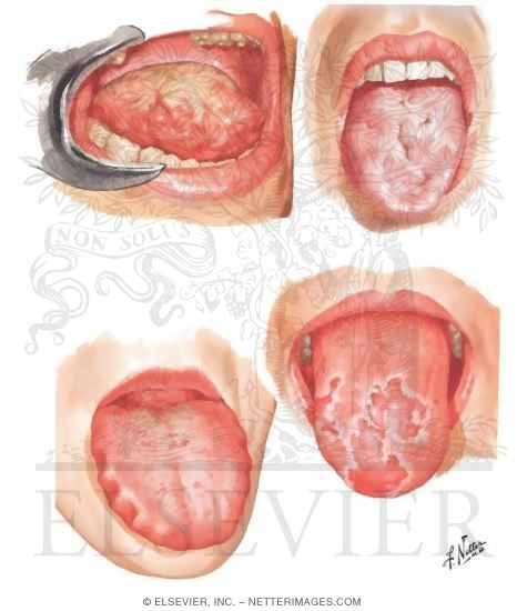 Watermarked preview of unlabeled image: Manifestations of Tongue