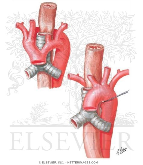 Double Aortic Arch, Dysphagia Lusoria