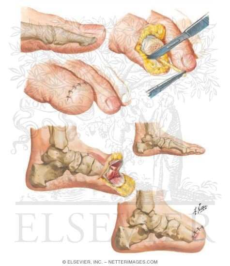 Toe Amputation - Transmetatarsal Amputation.