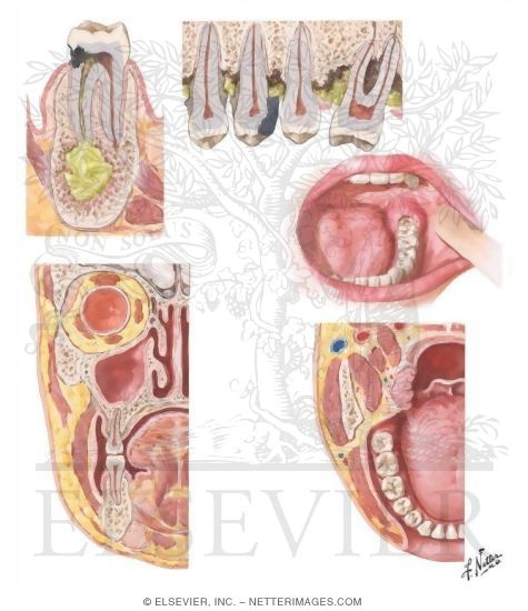 Odontogenic Infections - Their Spread and Abscess Formation