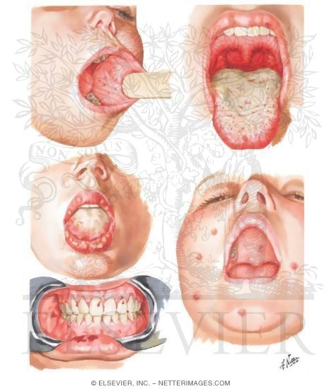 Watermarked preview of unlabeled image: Oral Manifestations in Systemic Infections