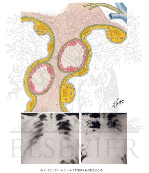 Watermarked preview of unlabeled image: Pulmonary Edema
