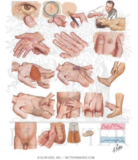 Watermarked preview of unlabeled image: Physical Diagnosis of Liver Disease
