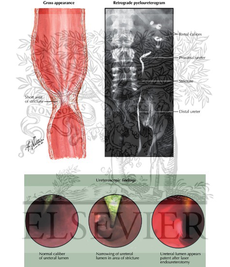 Watermarked preview of unlabeled image: Ureteral Strictures