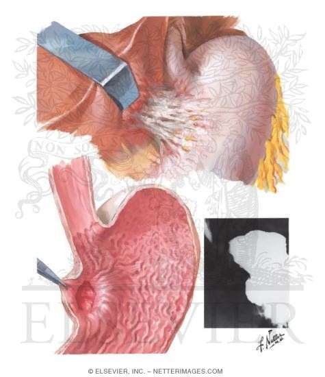 Watermarked preview of unlabeled image: Peptic Ulcer IV - Ulcer Near Cardia