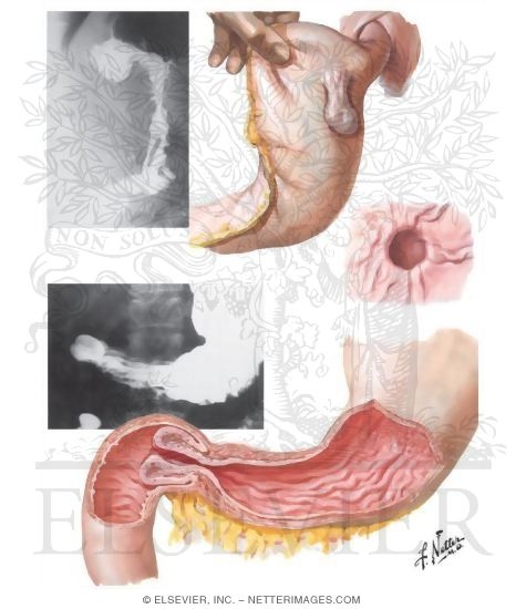 Watermarked preview of unlabeled image: Diverticulum of Stomach, Gastroduodenal Prolapse
