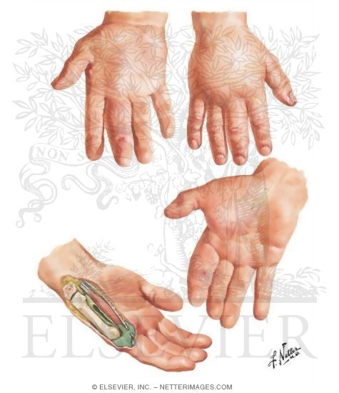 Surgical Anatomy of Hand
Disorders: Masses and Tumors
Deep Space Infections