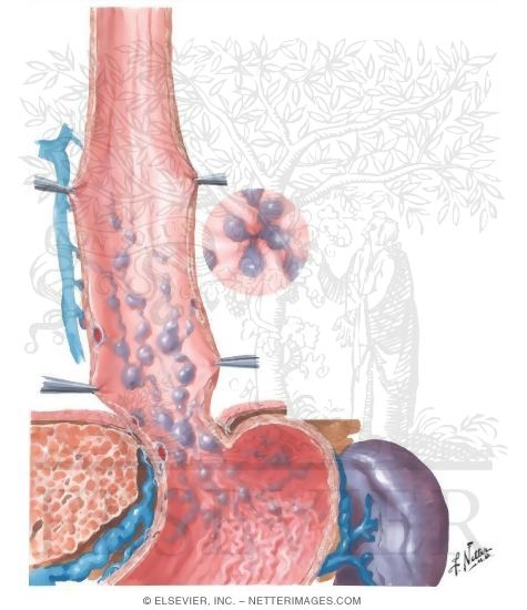 Watermarked preview of unlabeled image: Varicosis