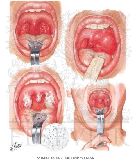 Watermarked preview of unlabeled image: Infections of Pharynx