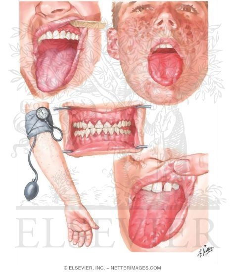 Oral Manifestations in Nutritional Deficiencies