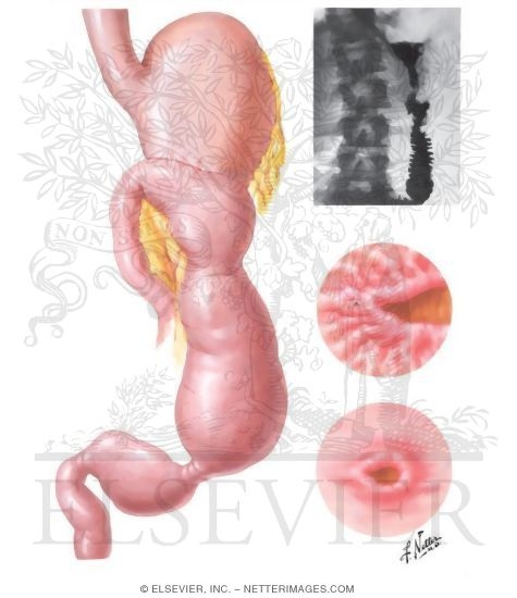 Postgastrectomy Complications Partial Gastrectomy
