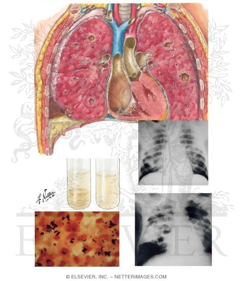 Staphylococcal Pneumonia