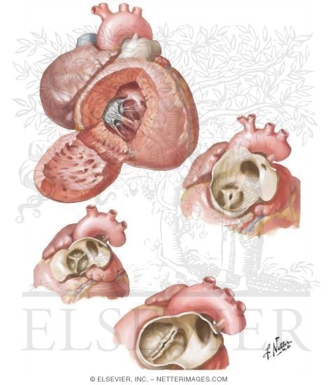 Watermarked preview of unlabeled image: Anomalies of the Right Ventricular Outflow Tract
Pulmonary Valvular Stenosis and Atresia