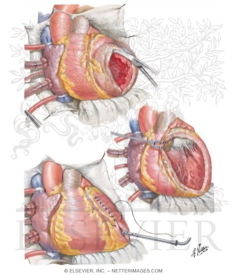 Watermarked preview of unlabeled image: Ventricular Aneurysmectomy