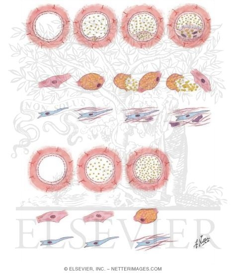 Hypothesis on Pathogenesis of Human Atherosclerosis