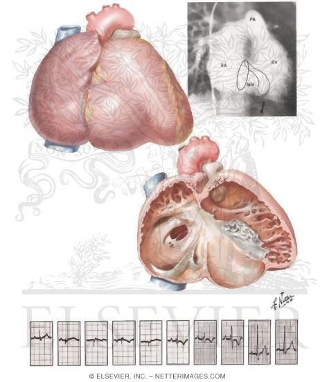 Watermarked preview of unlabeled image: Anomalies of the Tricuspid Valve
Ebstein's Malformation