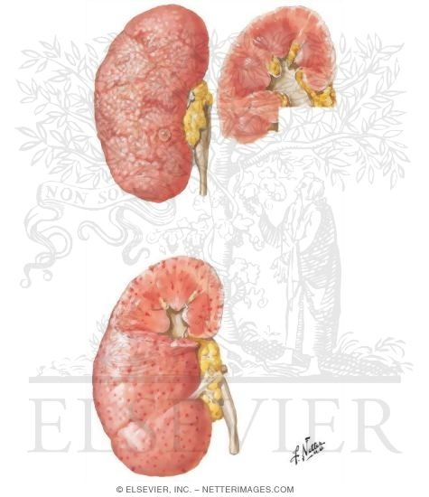 Watermarked preview of unlabeled image: Kidneys in Hypertension