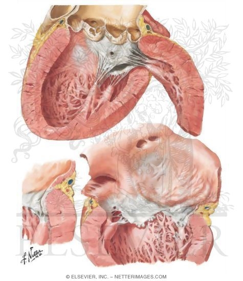 Watermarked preview of unlabeled image: Bacterial Endocarditis - Cardiac Sequelae