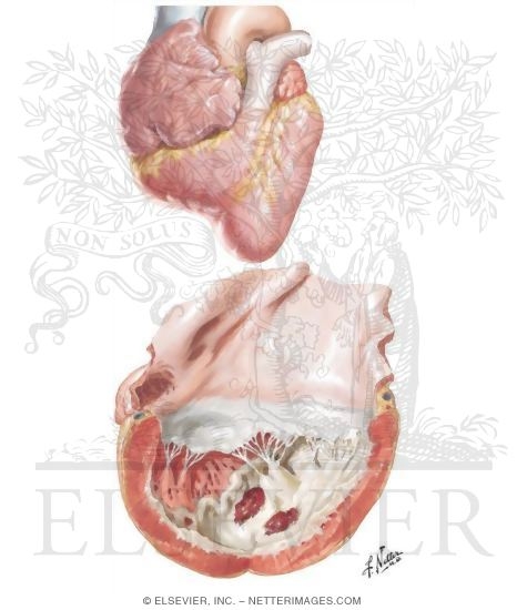 Watermarked preview of unlabeled image: Endomyocardial Fibrosis