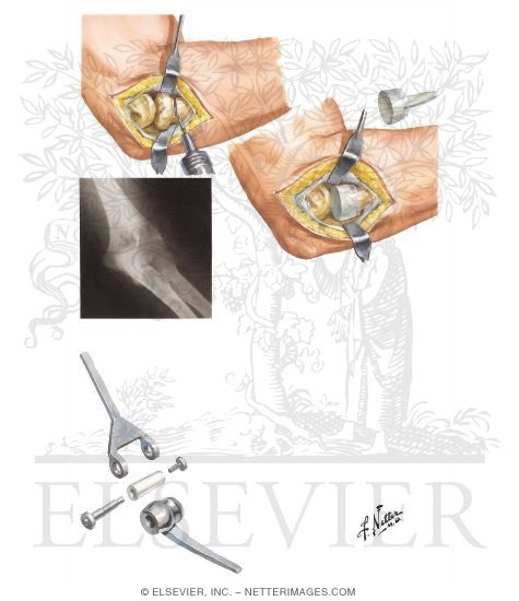 Watermarked preview of unlabeled image: Radial Head Implant Arthroplasty - Total Elbow Replacement
