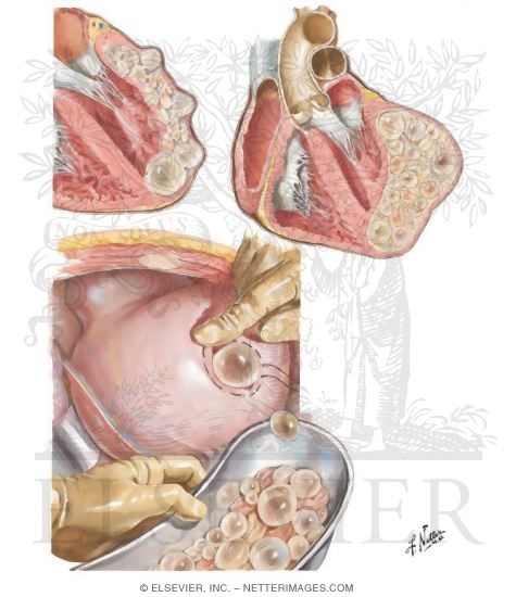 Echinococcus Cyst (Hydatid Disease)
