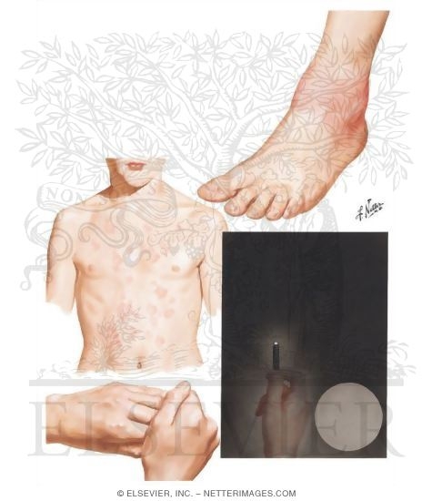 Rheumatic Fever; Sydenham's Chorea