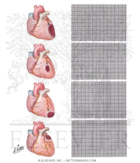 Localization of Anterior Infarcts