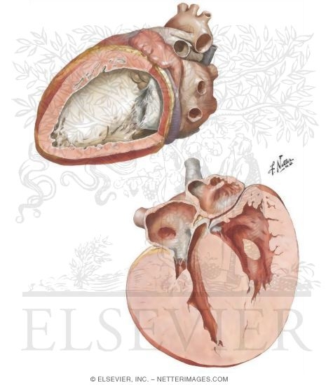 Watermarked preview of unlabeled image: Endocardial Fibroelastosis and Glycogen Storage Disease