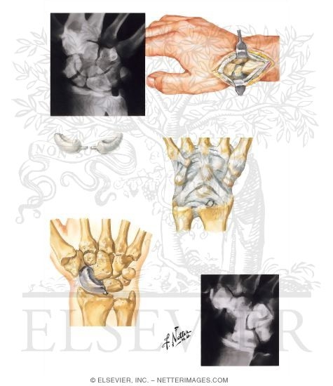 Watermarked preview of unlabeled image: Implant Arthroplasty for Carpal Scaphoid Bone