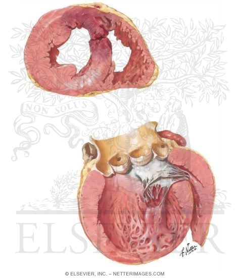 Watermarked preview of unlabeled image: Arteriosclerotic Heart Disease