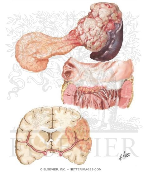 Marantic Endocarditis