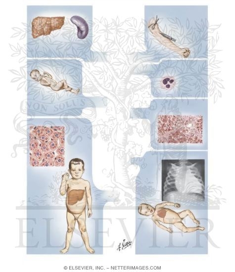 Watermarked preview of unlabeled image: Glycogen Storage Diseases