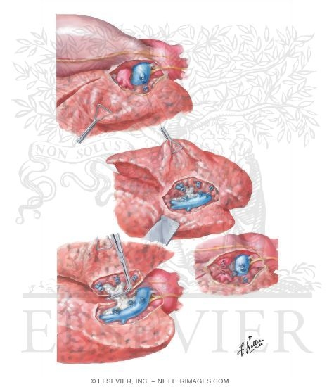 Lobectomy (Left Upper Lobe)
