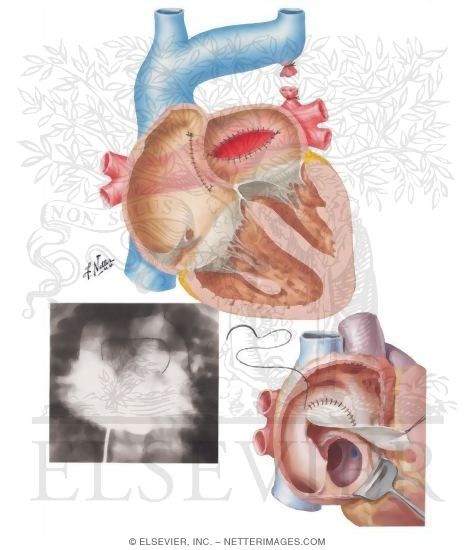 Watermarked preview of unlabeled image: Anomalous Pulmonary Venous Connection