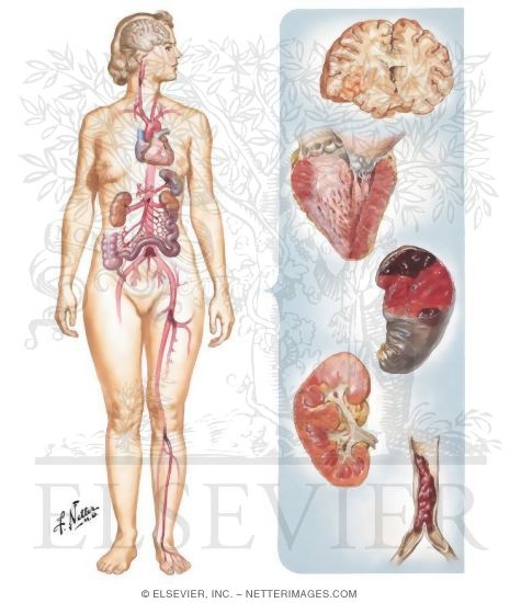 Watermarked preview of unlabeled image: Rheumatic Heart Disease VIII - Mitral Stenosis: Thromboembolic Complications