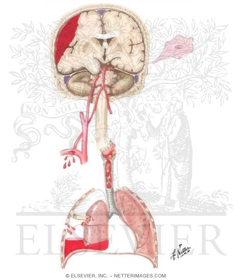 Watermarked preview of unlabeled image: Causes and Effects of Impaired Respiratory Exchange