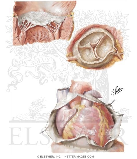 Watermarked preview of unlabeled image: Rheumatic Heart Disease III-Residual Changes of Acute Rheumatic Carditis