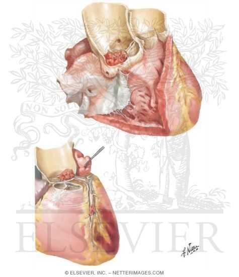 Watermarked preview of unlabeled image: Bacterial Endocarditis VI - Mycotic Aneurysms and Emboli in the Heart