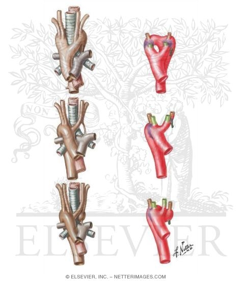 Watermarked preview of unlabeled image: Aortic Arch Anomalies