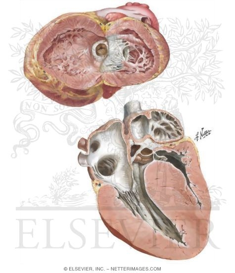 Watermarked preview of unlabeled image: Anomalies of the Left Ventricular Outflow Tract