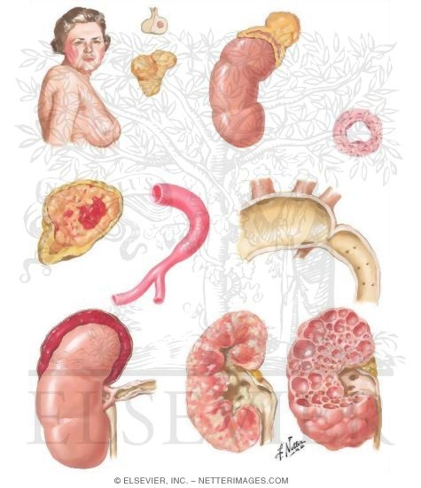 Watermarked preview of unlabeled image: Causes of Secondary Hypertension Possibly Amenable to Surgery