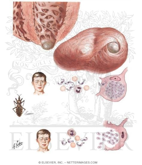 Watermarked preview of unlabeled image: Chagas' Disease