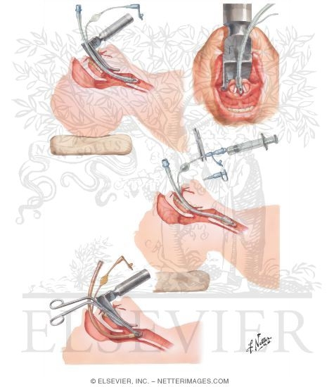 Watermarked preview of unlabeled image: Endotracheal Intubation