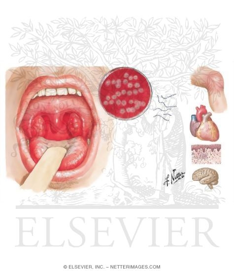 Rheumatic Fever; Sydenham's Chorea
