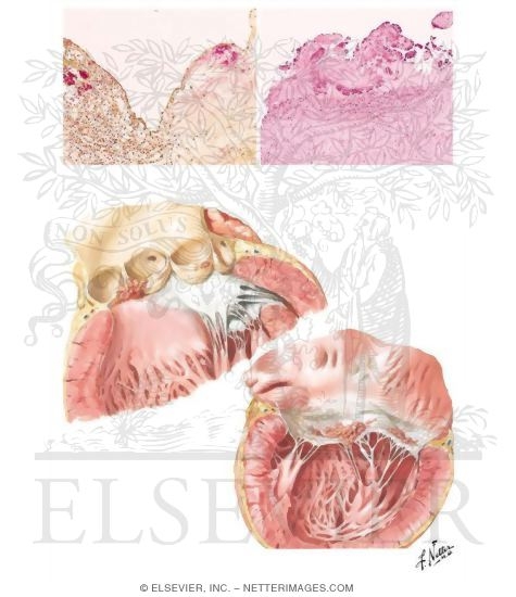 Watermarked preview of unlabeled image: Bacterial Endocarditis - Early Lesions
