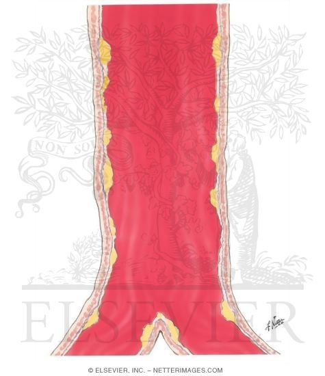 Watermarked preview of unlabeled image: Atherosclerosis